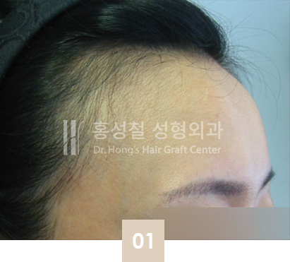 ヘアライン矯正前