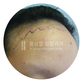 M字ラインに丸みを出し、ヘアラインを2cm下げるデザイン