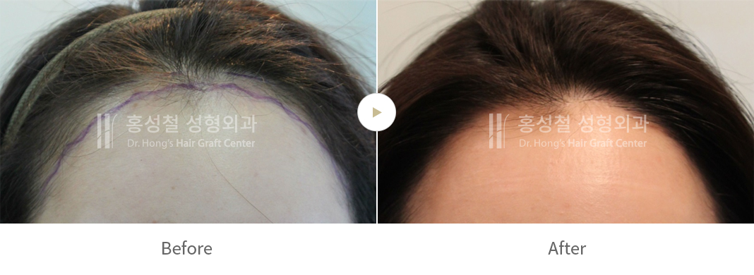 女性のヘアライン — 術前術後の写真